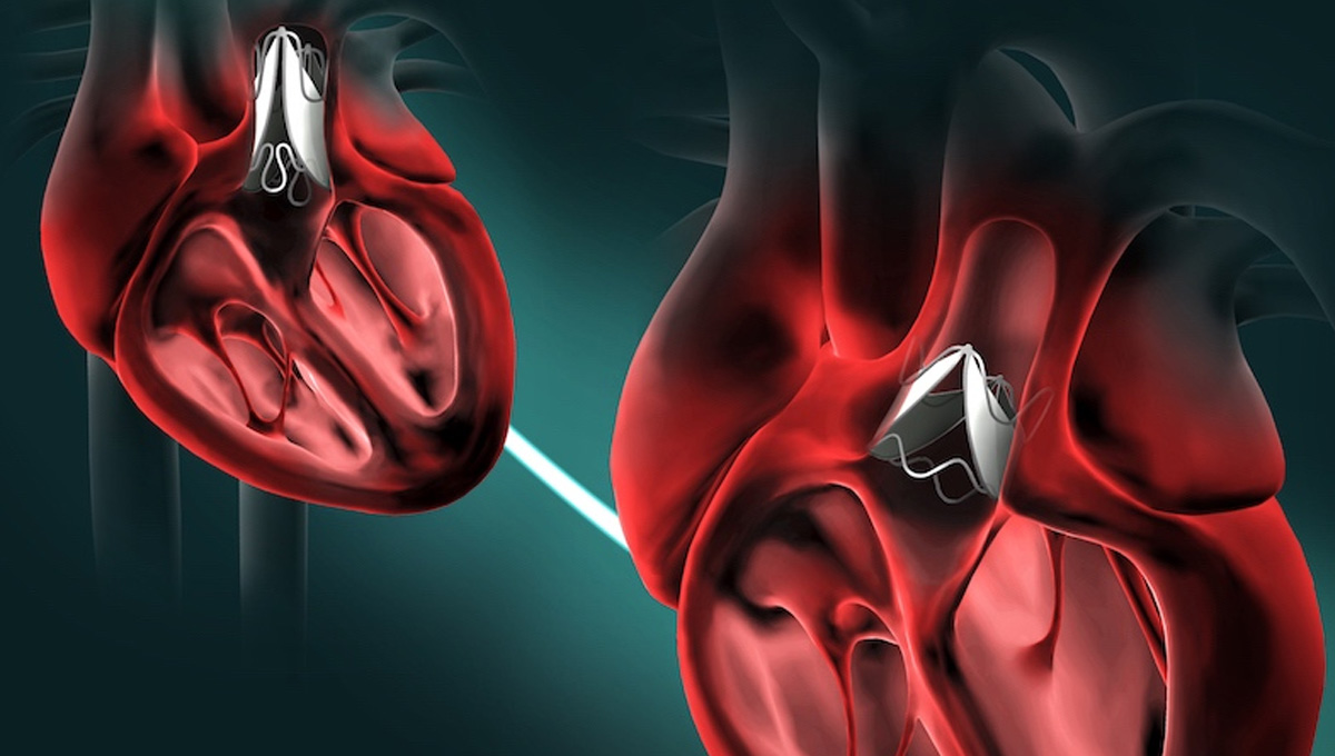 heart-valve.jpg
