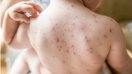 चिकनपॉक्स व मम्स बीमारी से बच्चे हो रहे ग्रसित, फैल रहा वायरल