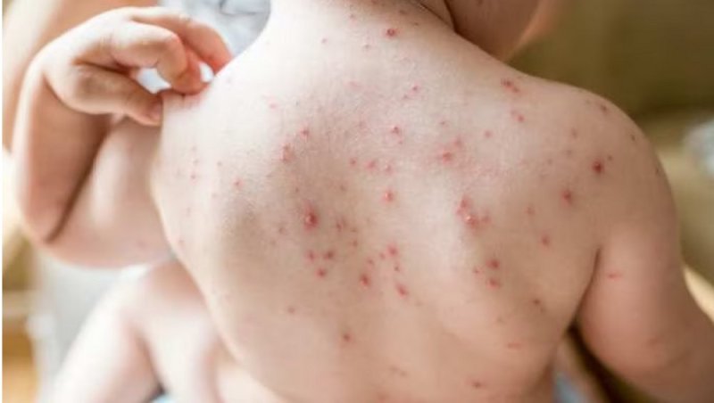 चिकनपॉक्स व मम्स बीमारी से बच्चे हो रहे ग्रसित, फैल रहा वायरल