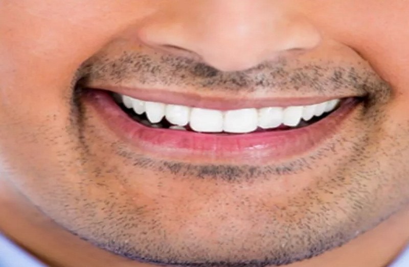 विवाह से पहले ‘स्माइल डिजाइनिंग’ सर्जरी के दौरान युवक की गई जान, क्लीनिक पर केस