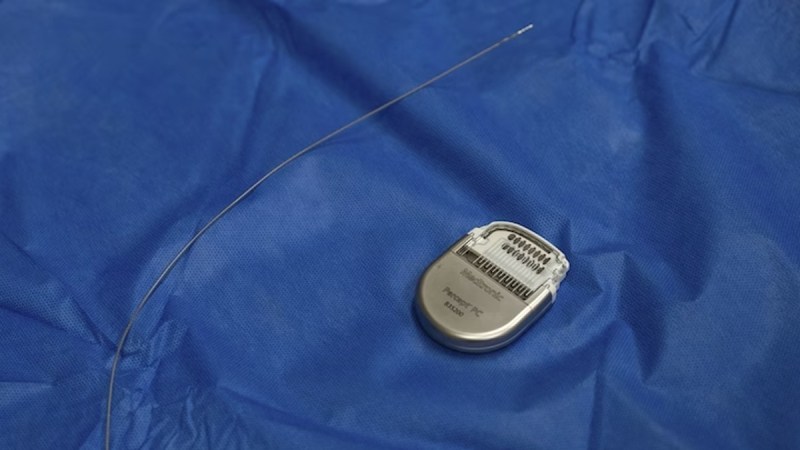 pacemaker-for-depression.jpg