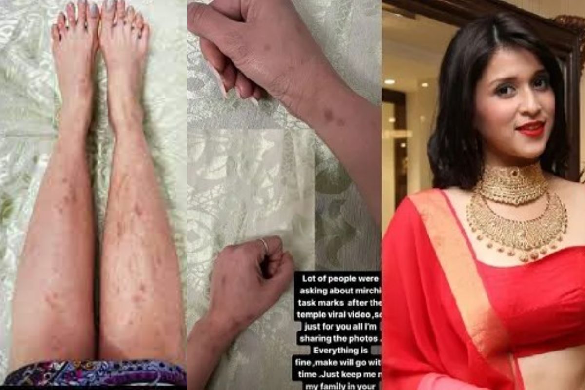 mannara_chopra_body_so_scary_bruises_on_hands_legs_torture_photo_viral.jpg