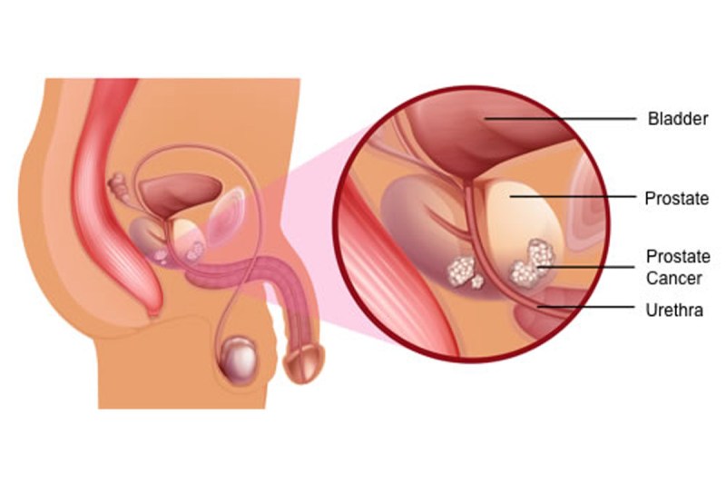 prostate-cancer.jpg