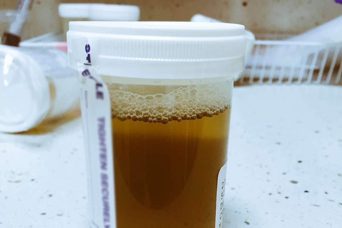 dark-brown-urine.jpg