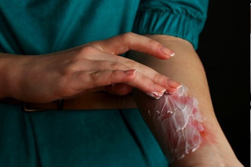 Do not make the mistake of rubbing ice or applying toothpaste on the burn.