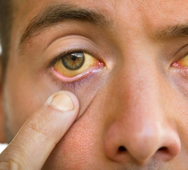 high cholesterol symptoms