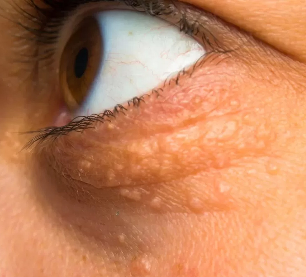 आंखों के आसपास दाने और त्वचा का रंग बदलना हो सकता है इस गंभीर बीमारी का संकेत - image