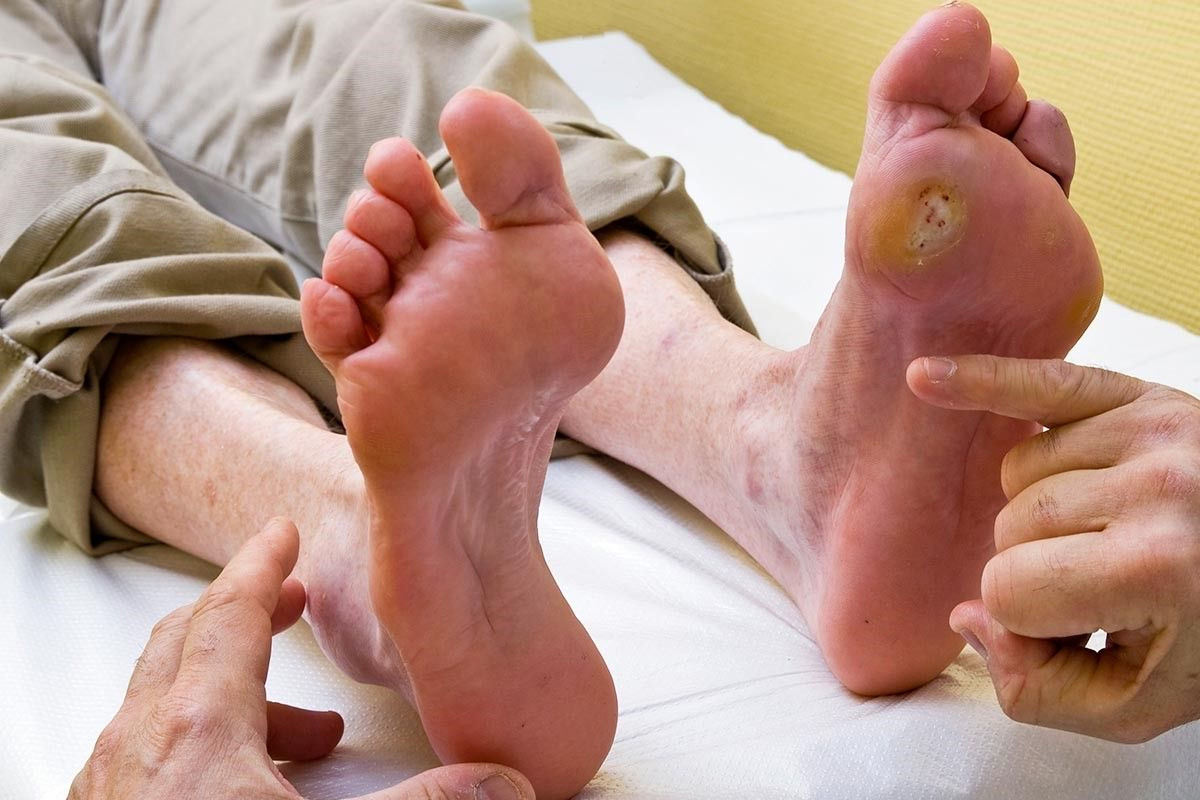 foot ulcer in diabetic patients
