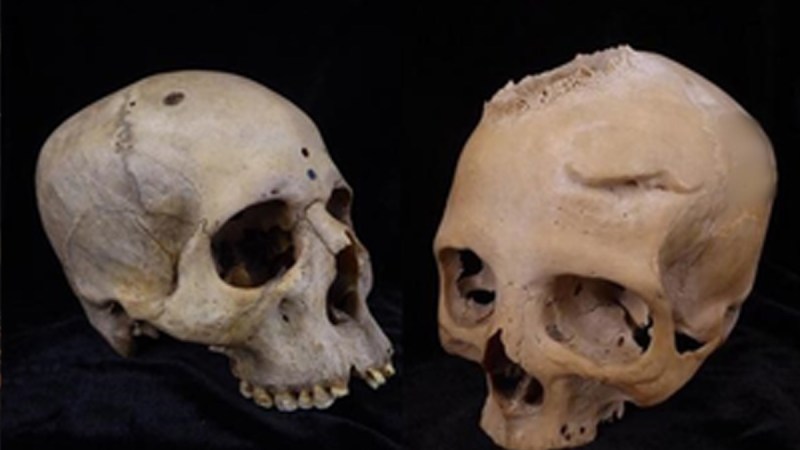 Ancient Egyptian surgery