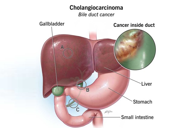 bile duct cancer symptoms