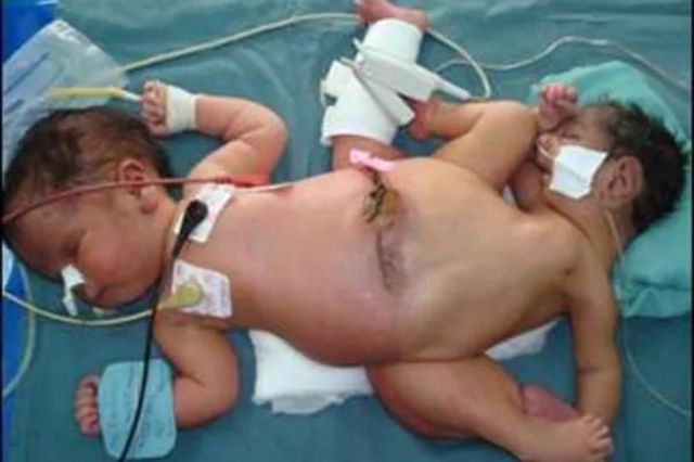 Twins with 4 arms, 3 legs born in Indonesia