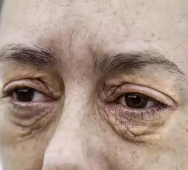 Cholesterol deposits on eyes and eyelids