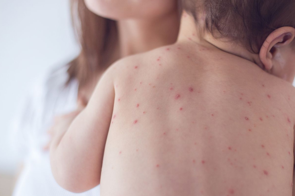 Measles vaccine : ऑपरेशन से पैदा हुए बच्चों में खसरे का टीका कम प्रभावी! - image