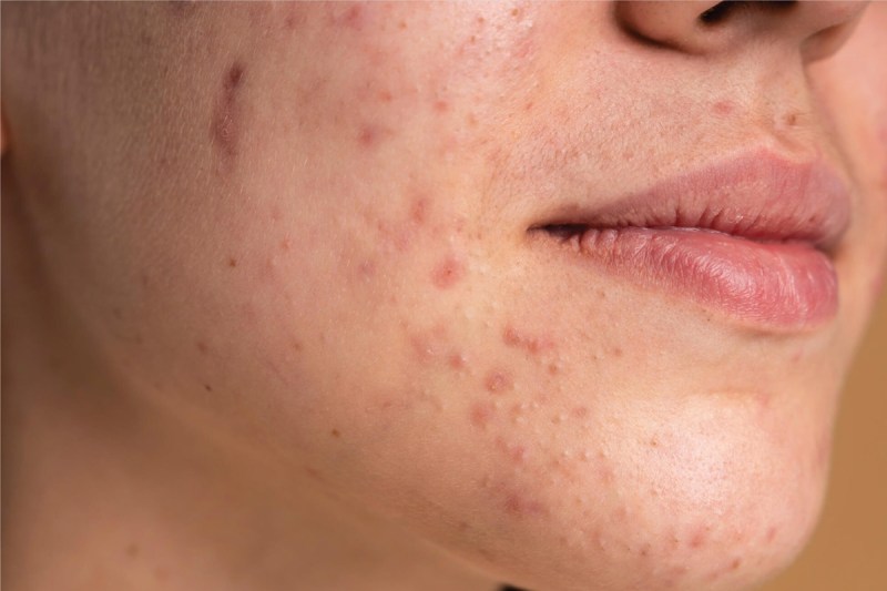 family history raises skin cancer risk more than sun exposure