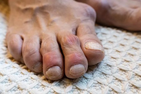 Reduce Uric Acid