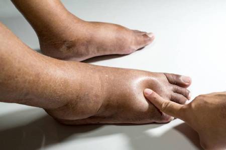 Diabetes Symptoms