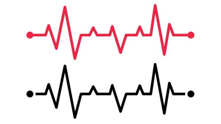 Irregular heartbeat
