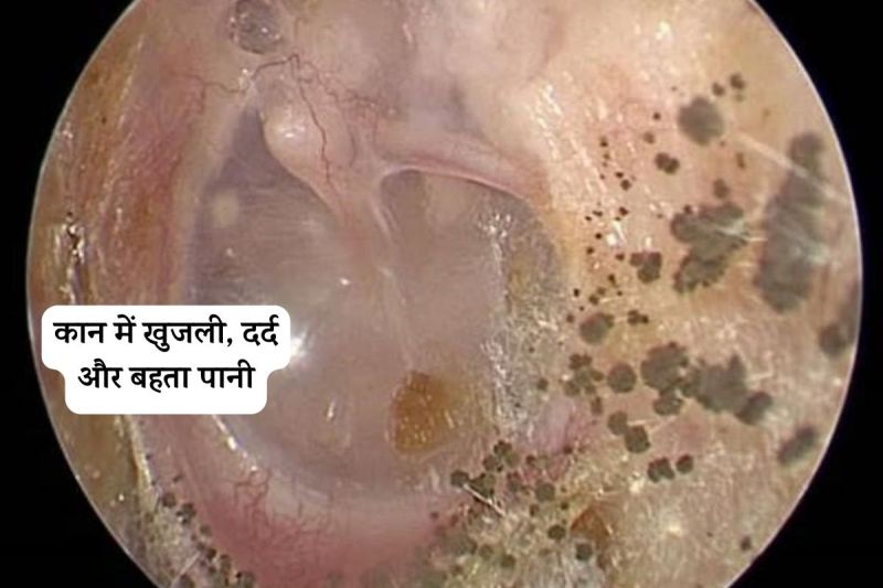 Fungal Ear Infections