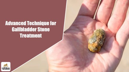 Advanced Technique for Gallbladder Stone Treatment