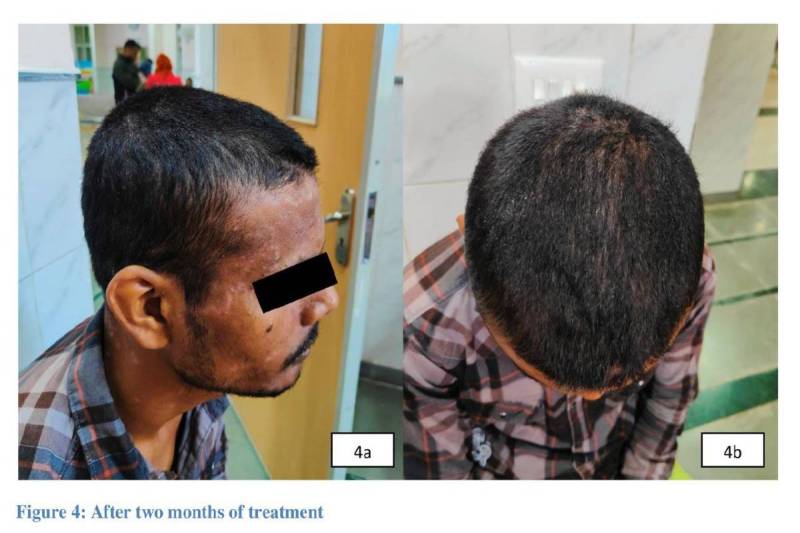 Scalp Psoriasis