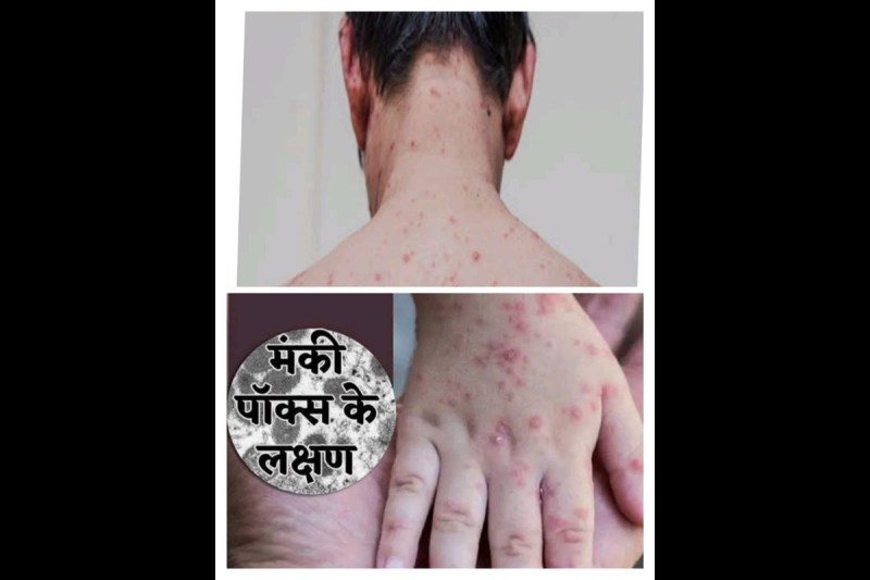 मंकी पॉक्स को लेकर स्वास्थ्य विभाग अलर्ट, जिला अस्पताल में वार्ड बनाया