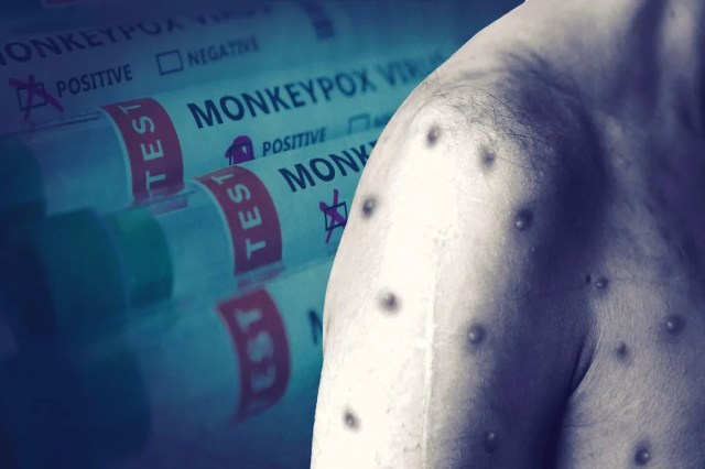 Monkeypox Alert 