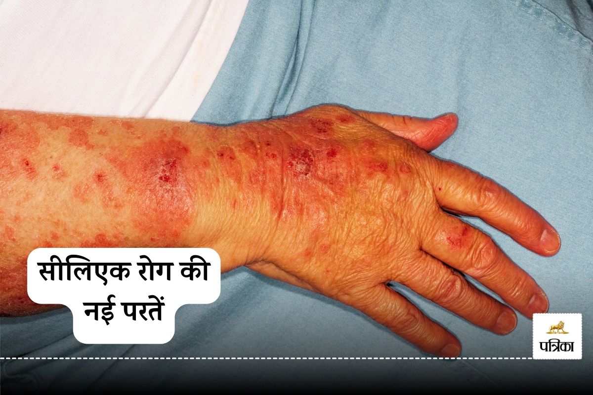 New Insights into Celiac Disease: The Crucial Role of the Epithelium Revealed