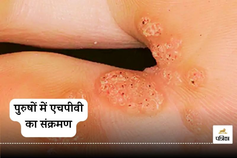 HPV infection in men