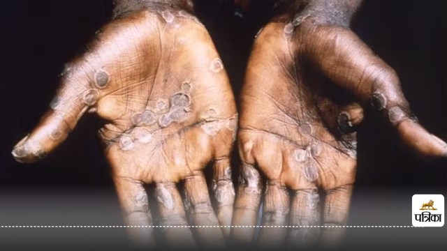 Monkeypox outbreak