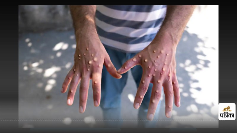 Monkeypox Prevention: Entry Point Screenings Launched in Every District