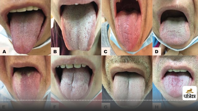 Relationship between tongue color and health