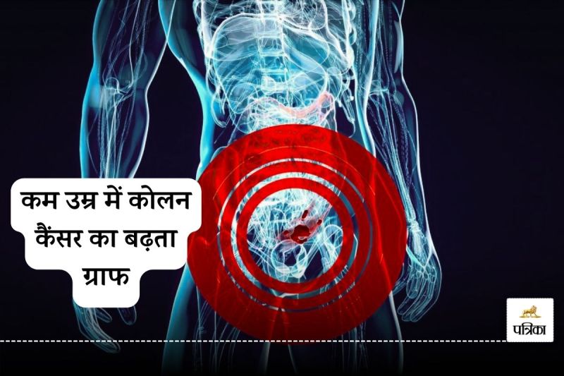 Increasing graph of colon cancer in young age