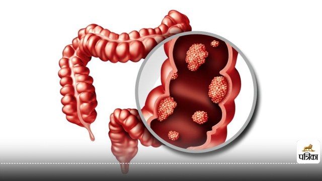 Increasing graph of colon cancer in young age