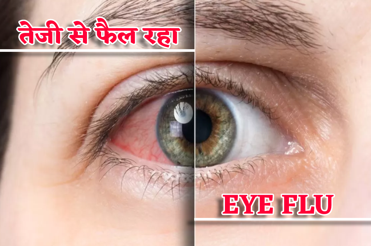 eye flu
