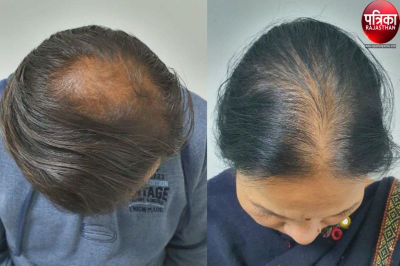 जवानी में उड़े बाल, जंक फूड, कलरिंग-स्ट्रेस बड़ा कारण