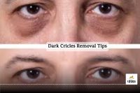 Dark Cricles Removal Tips : From tried to inspired, dark circle removal is the answer
