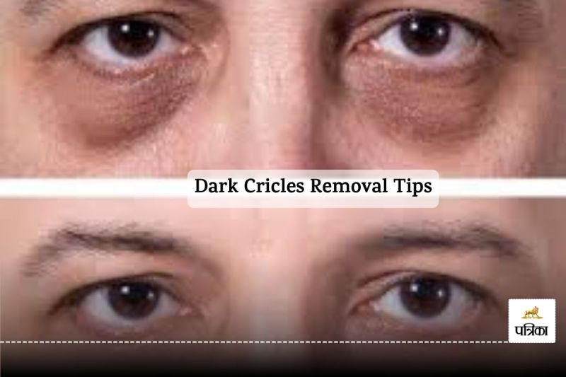 Dark Cricles Removal Tips : From tried to inspired, dark circle removal is the answer