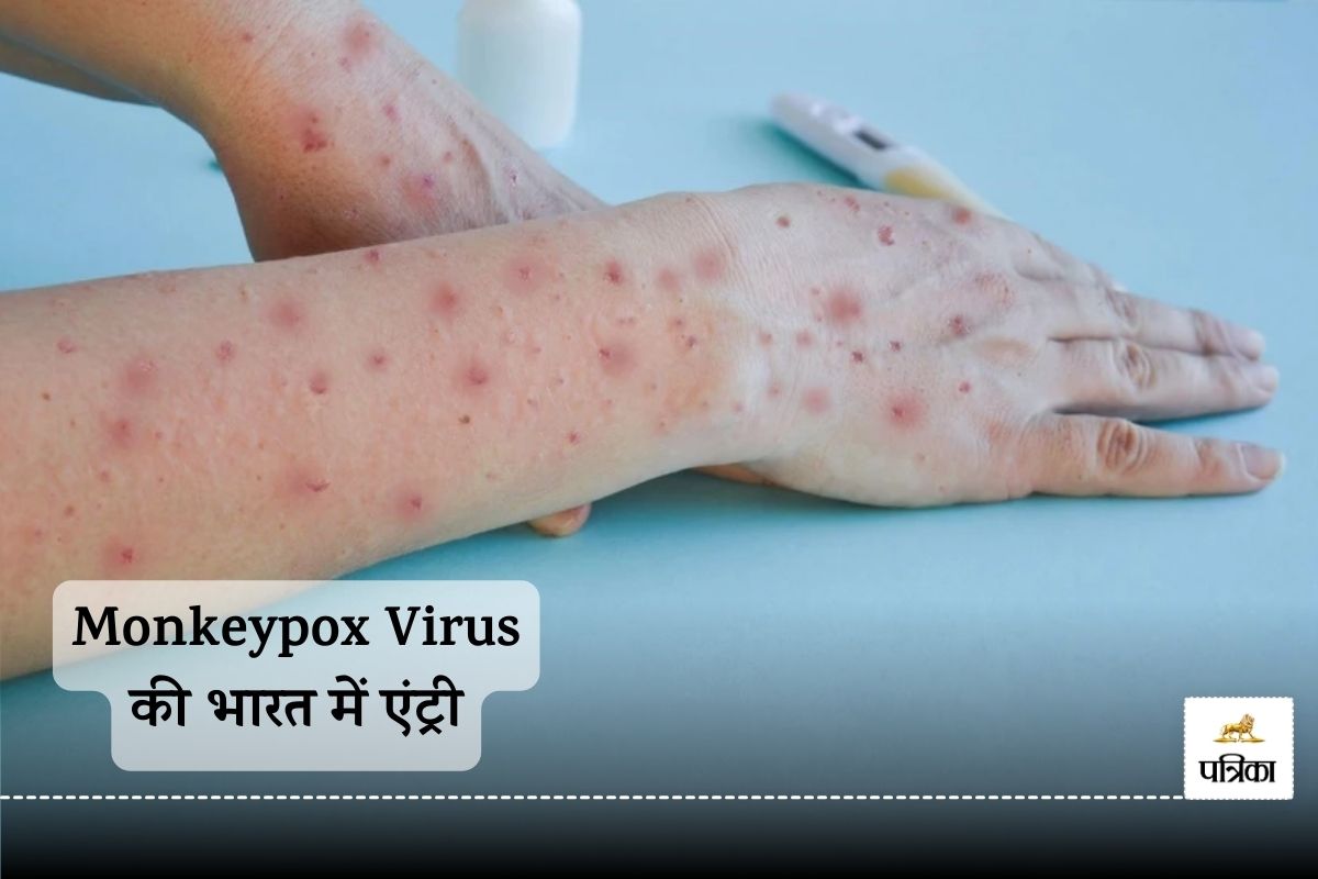 Monkeypox