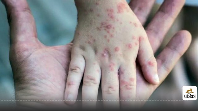 Symptoms of Mpox: Identification and Treatment