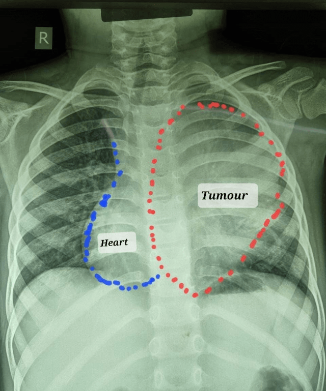 tumour 