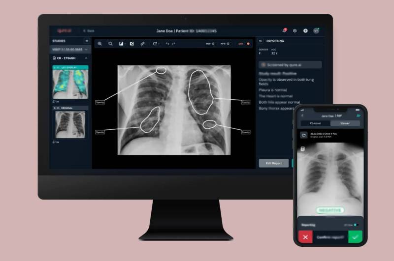 x-ray report on mobile