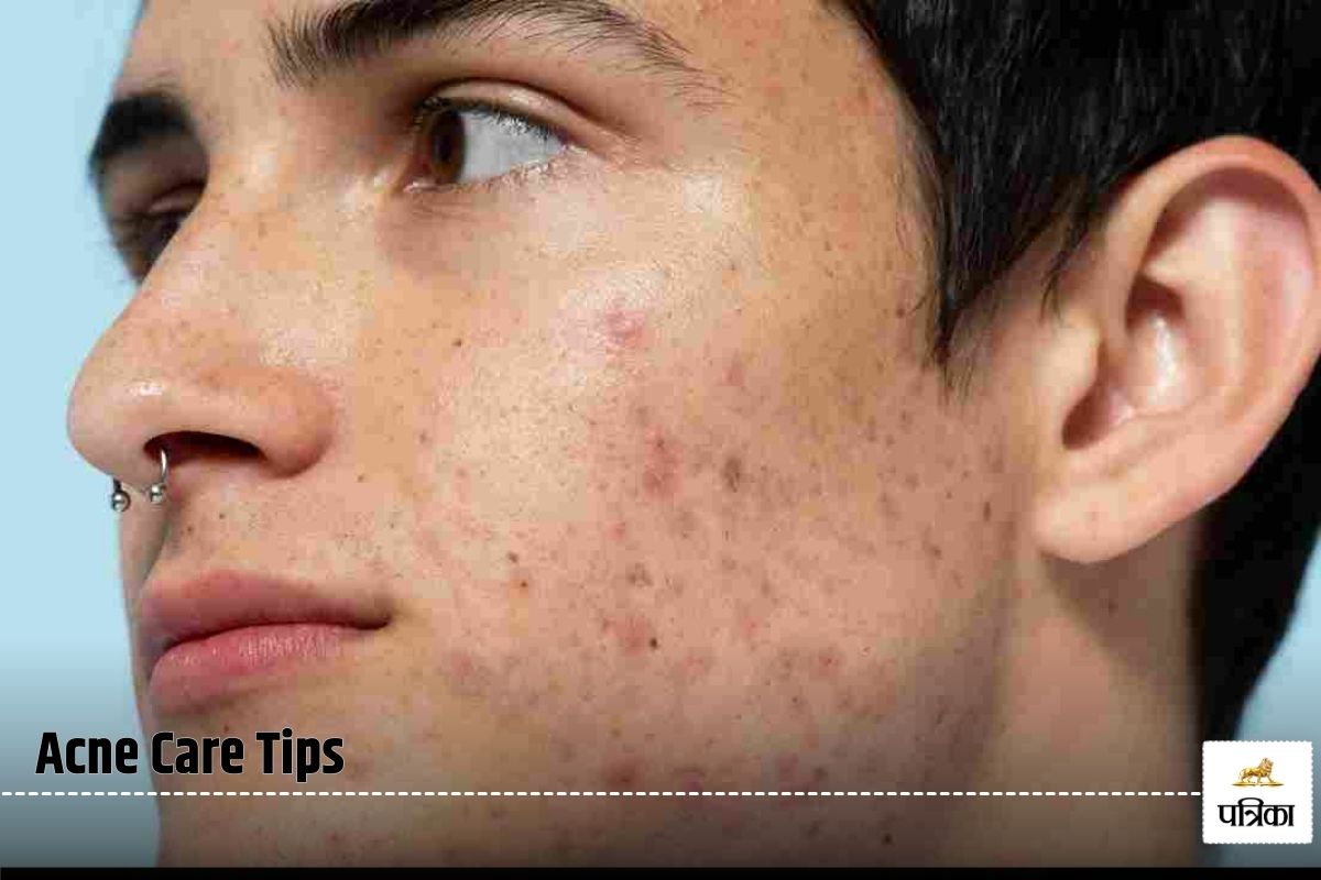 Acne Care Tips: क्या एक्ने के दाग नहीं हट रहे? तो आज ही आजमाएं ये घरेलू नुस्खें