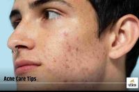 Acne Care Tips: Are Acne Stains Not Removed? So try these home remedies today
