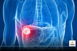 Liver Cancer : क्यों होता है Liver cancer, जानिए कारण और कैसे इससे बच सकते हैं? - image