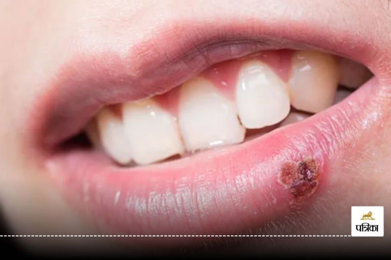 If you are also troubled by blisters around the mouth, then it could be a cold sores, know what are its symptoms