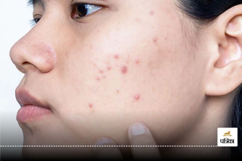 Beard Side effects for Girl