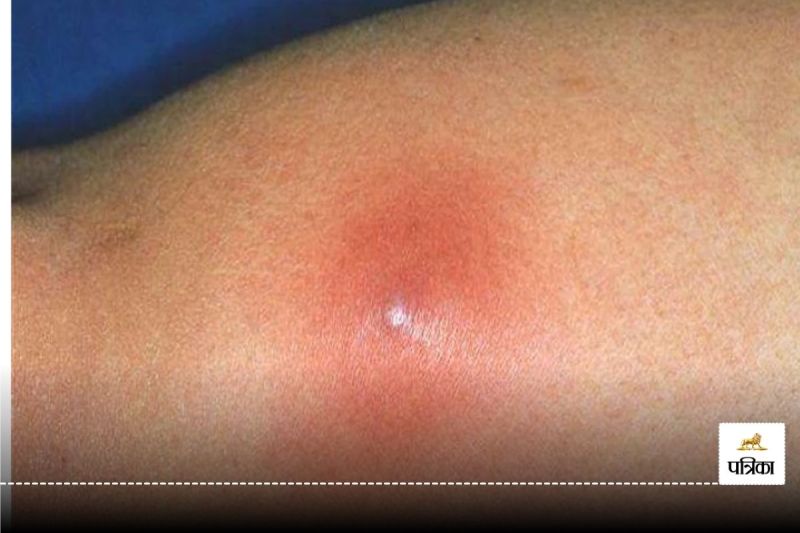 Baltod ka gharelu upachar : If you are also troubled by Baltod, then follow these home remedies