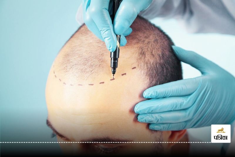 Are you also thinking of getting a hair transplant? First know the truth