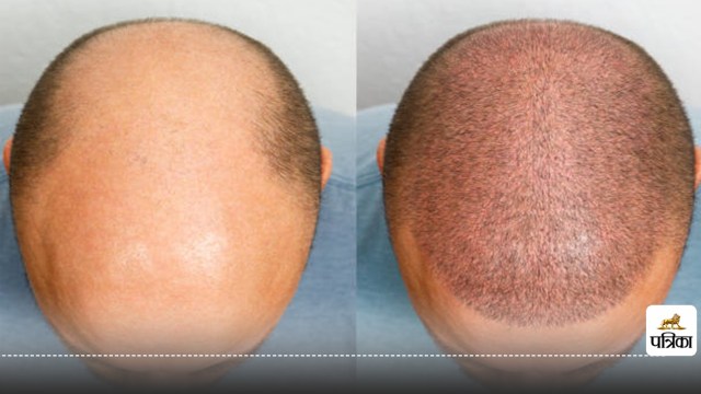 Hair Transplant: Is It the Right Choice? Discover the Facts