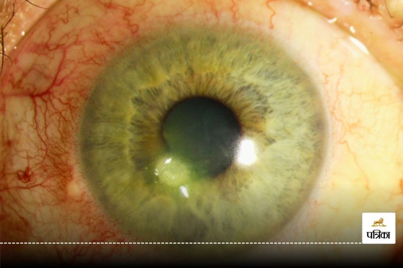 Artificial Intelligence Keratitis detection